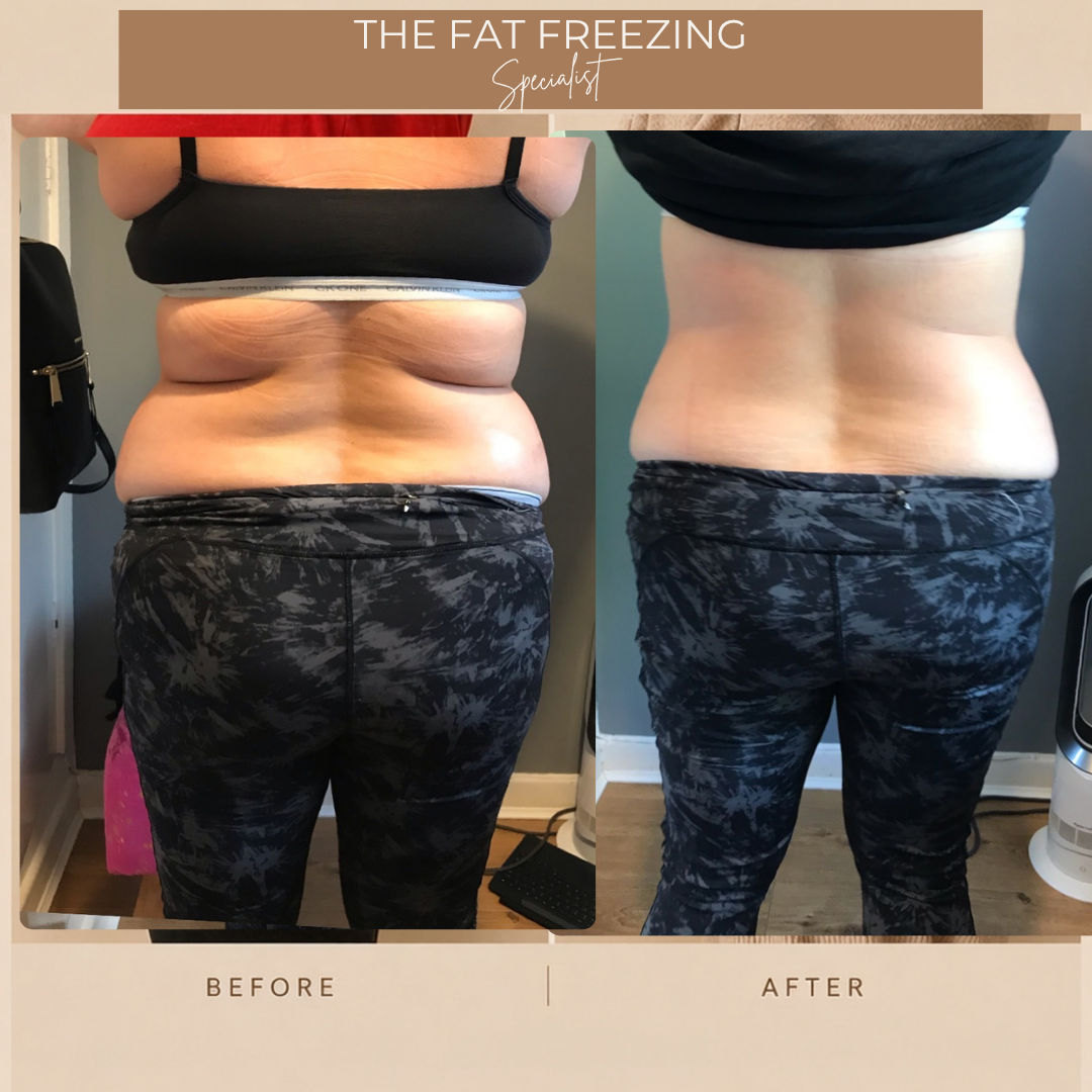 Before and after fat freezing on the lower back, rear view