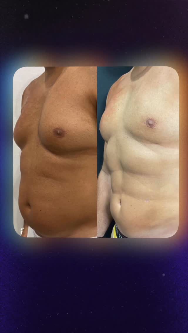 Body contouring procedures Dubai