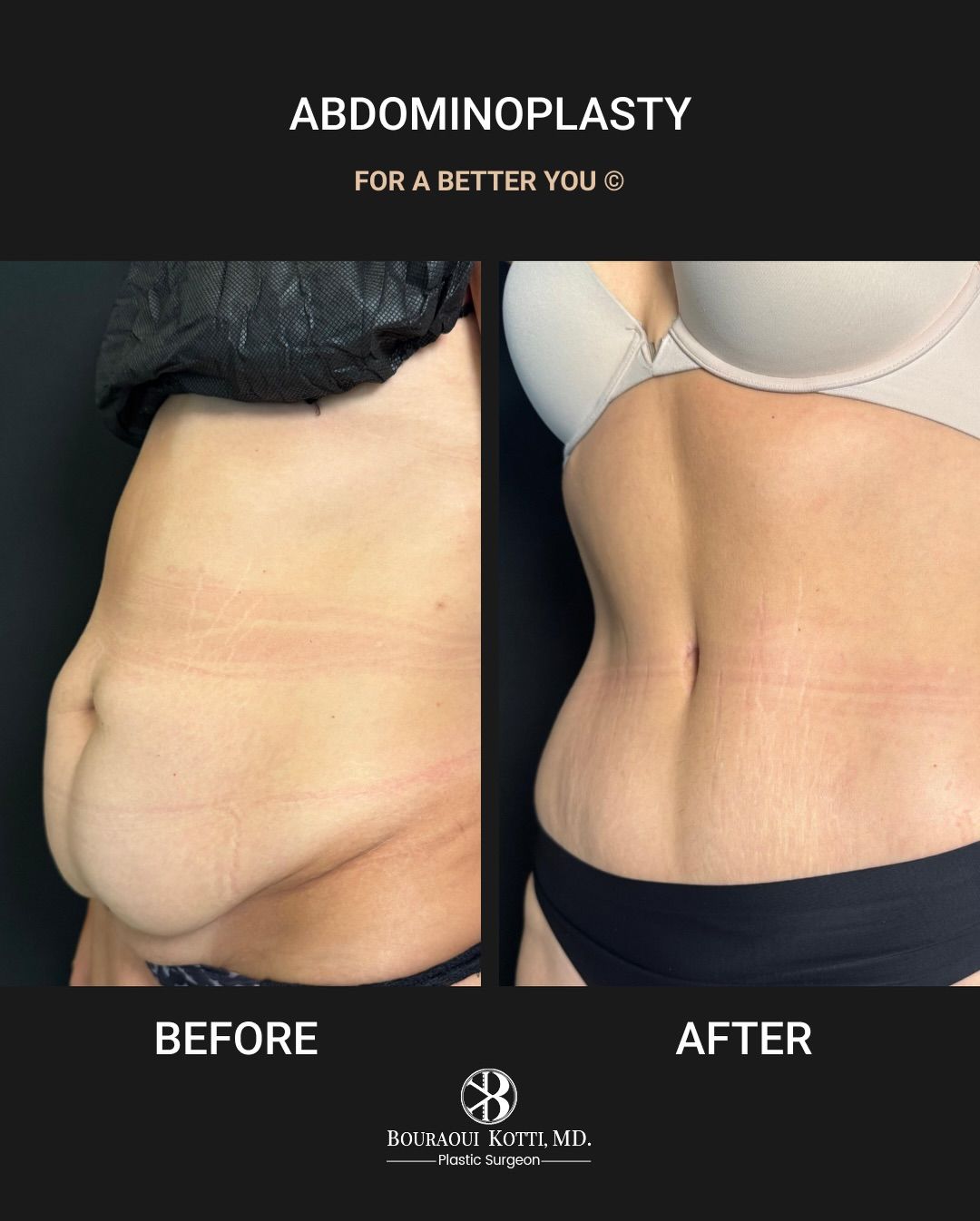 Abdominoplasty Before & After — Dr. Bouraoui Kotti MD PhD, Plastic Surgeon Dubai