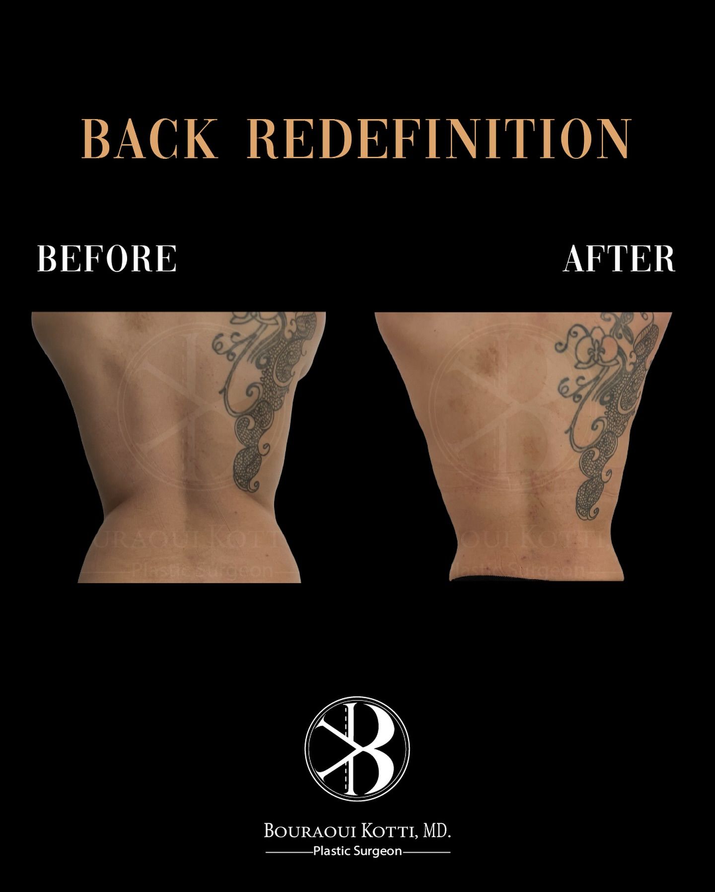 Back re-definition Before & After — Dr. Bouraoui Kotti MD PhD, Plastic Surgeon Dubai