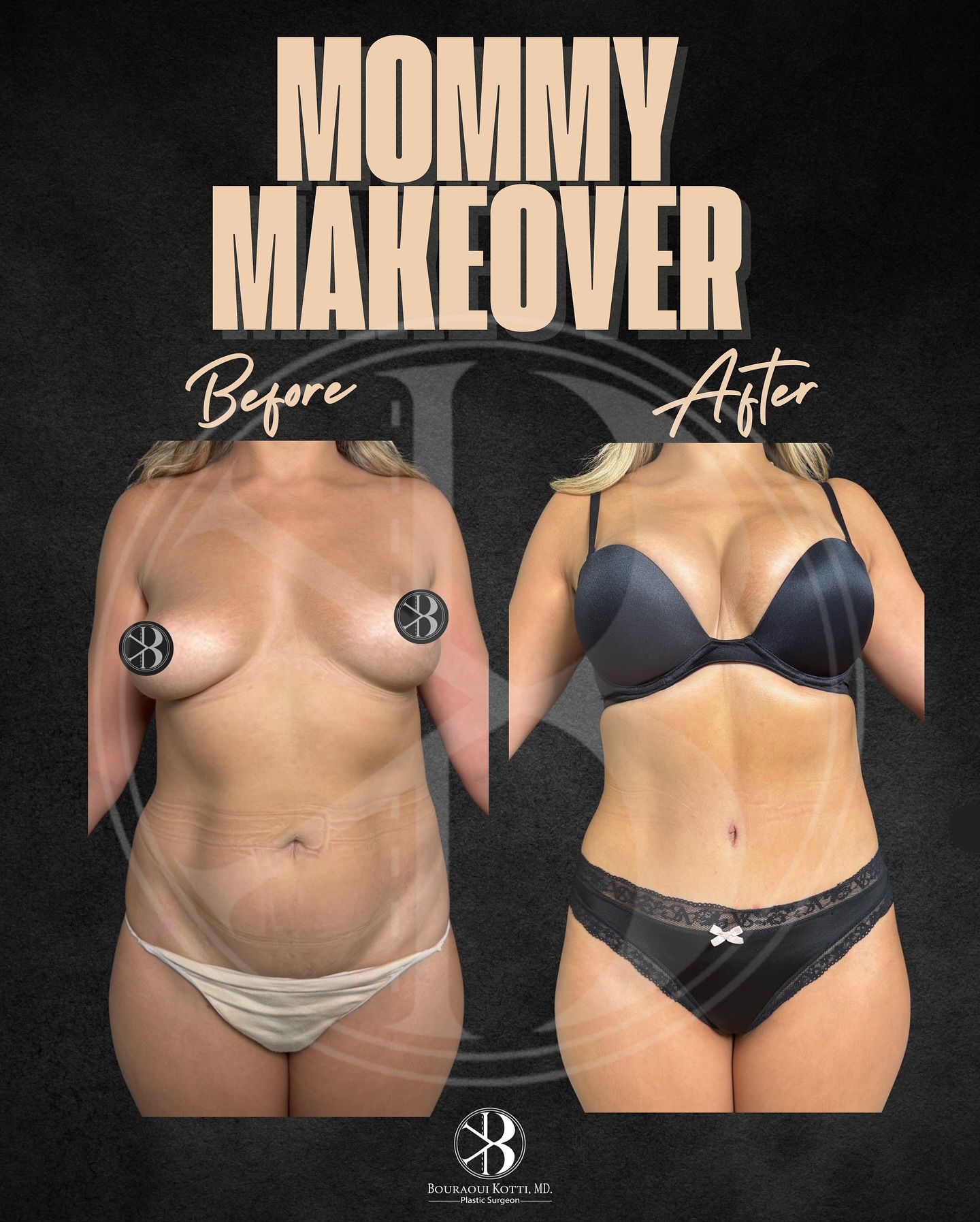 Mommy Makeover Before & After — Dr. Bouraoui Kotti MD PhD, Plastic Surgeon Dubai