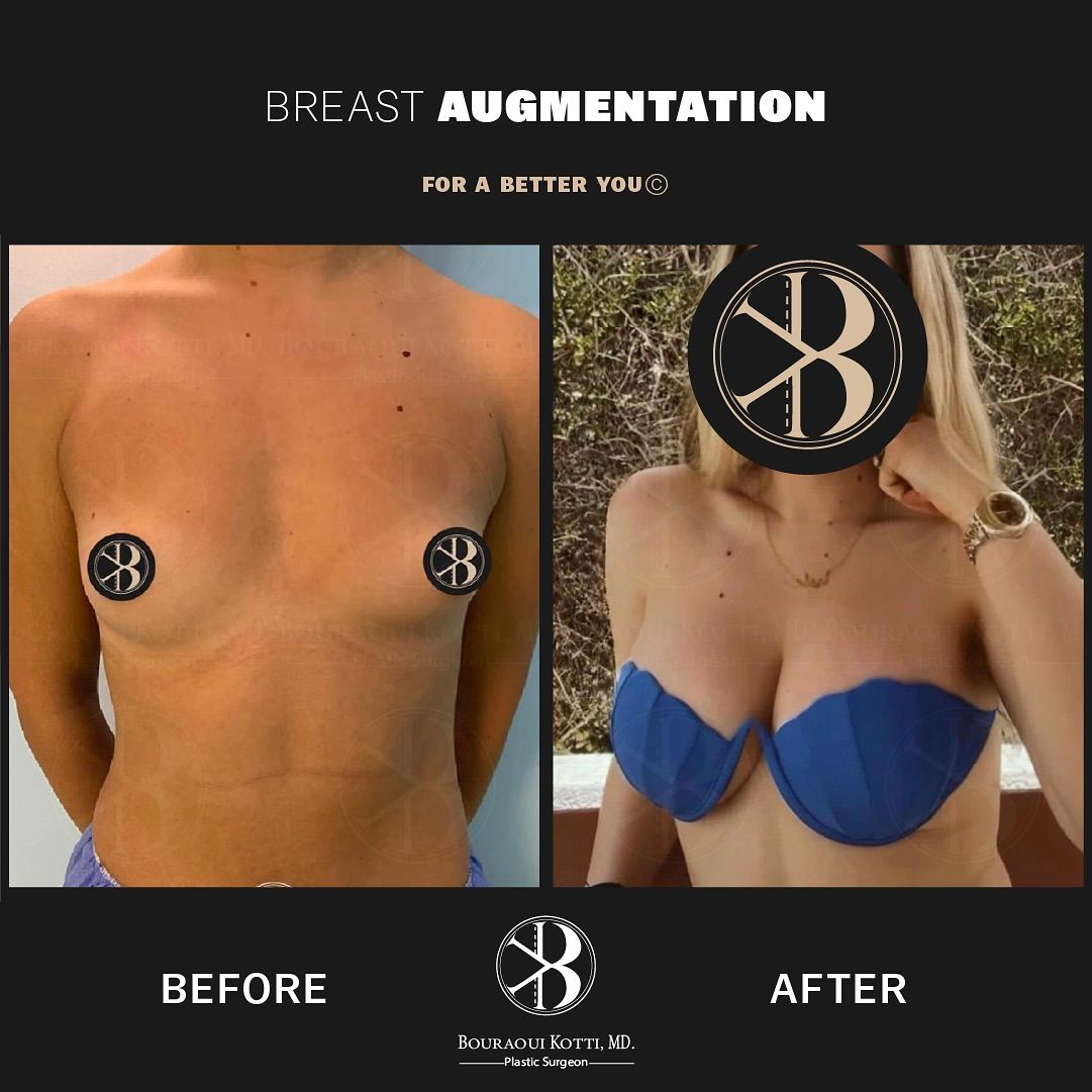 Breast augmentation Before & After — Dr. Bouraoui Kotti MD PhD, Plastic Surgeon Dubai