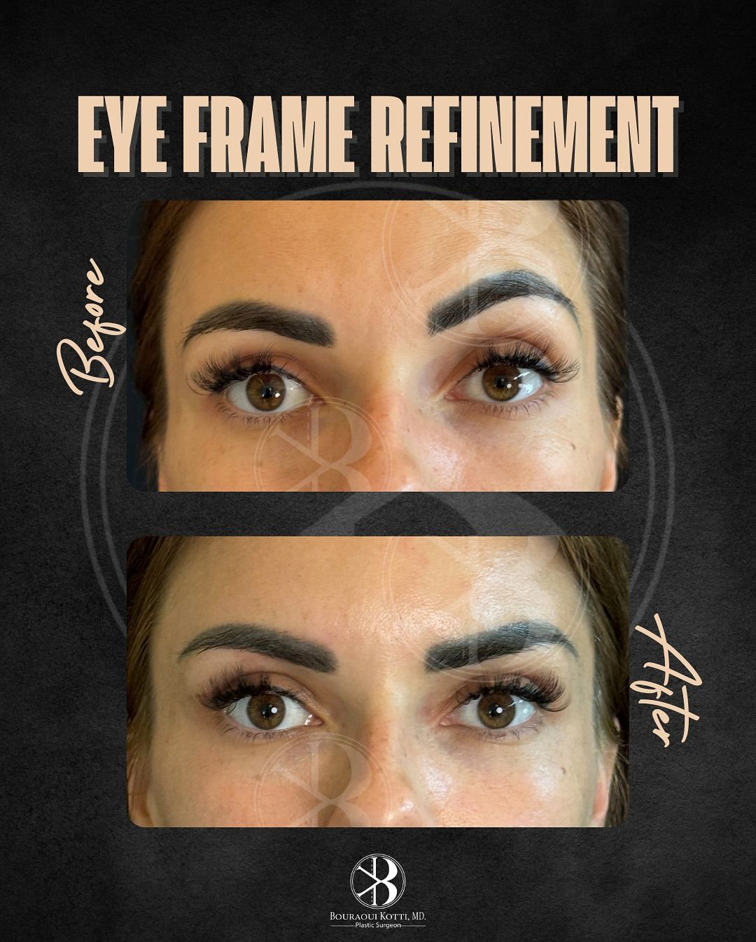 eye frame refinement Before & After — Dr. Bouraoui Kotti MD PhD, Plastic Surgeon Dubai