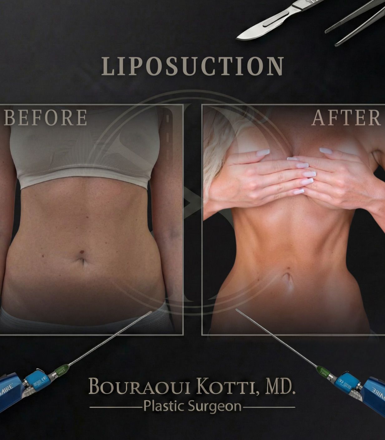 Liposuction Before & After — Dr. Bouraoui Kotti MD PhD, Plastic Surgeon Dubai