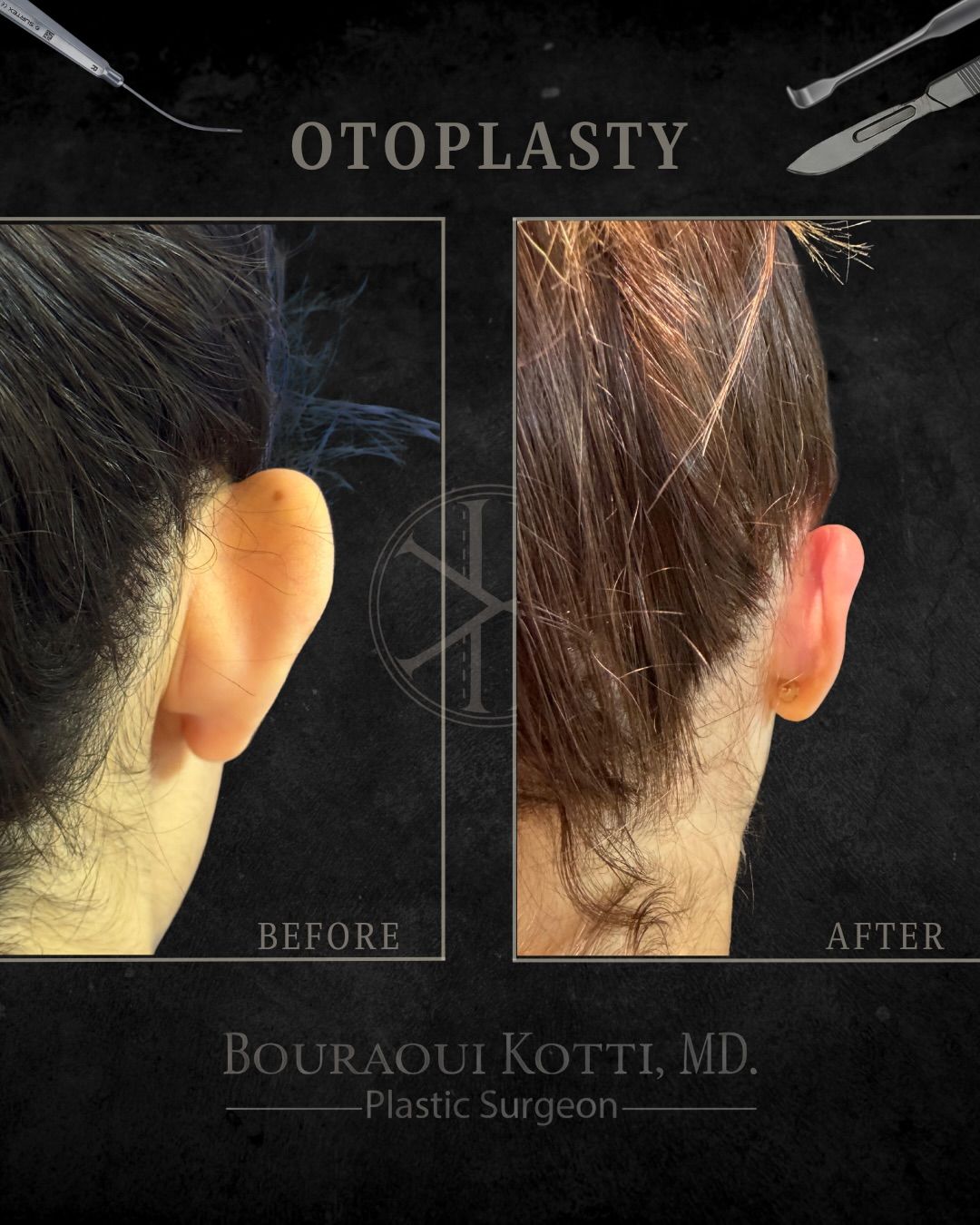 Otoplasty Before & After — Dr. Bouraoui Kotti MD PhD, Plastic Surgeon Dubai
