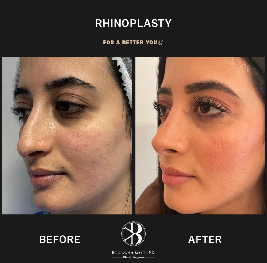 Rhinoplasty Before & After — Dr. Bouraoui Kotti MD PhD, Plastic Surgeon Dubai