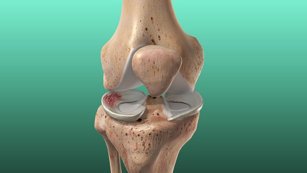 Meniscus Tear overview