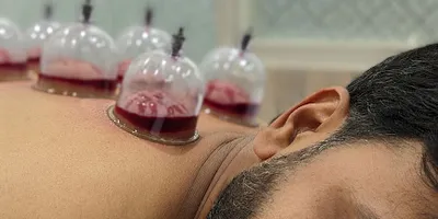 Cupping Therapy for muscle relaxation