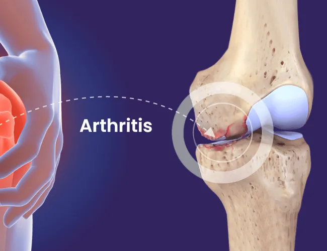 Arthritis symptoms