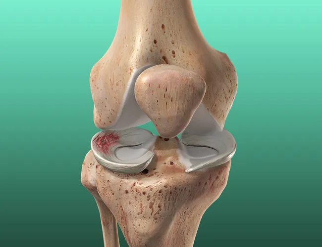 Meniscus Tear symptoms