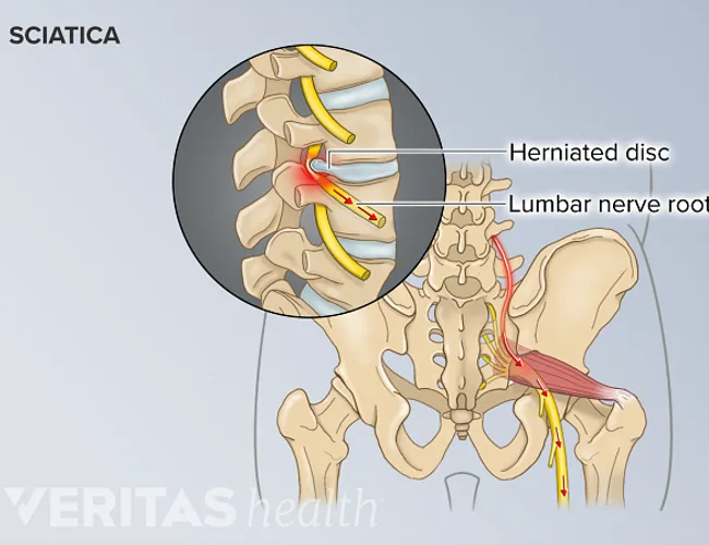 Sciatica Pain causes