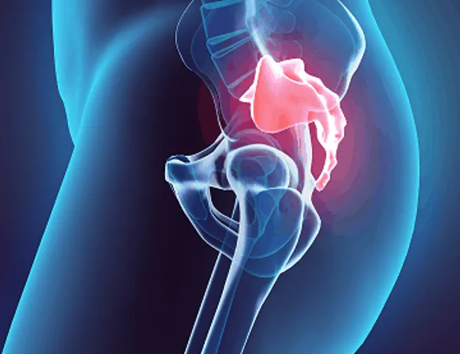 Coccydynia symptoms