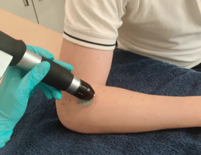 Tennis Elbow treatment