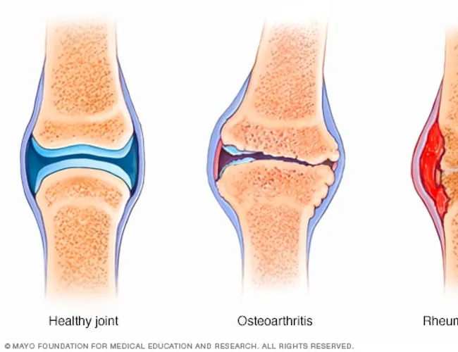 Arthritis causes