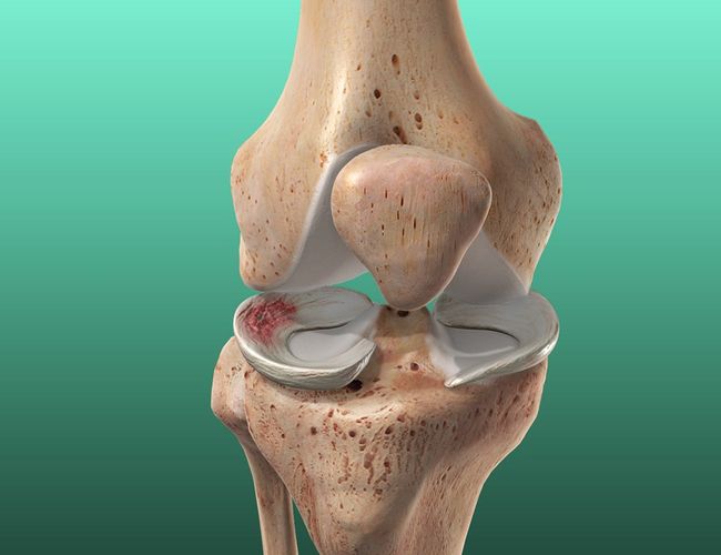 Meniscus Tear image