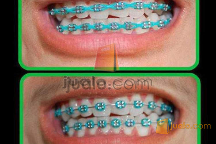 Behel Fashion Lepas Pasang Permanen Murah Asli Madiun Jualo Behel Fashion Lepas Pasang Permanen Murah Asli Madiun Jualo