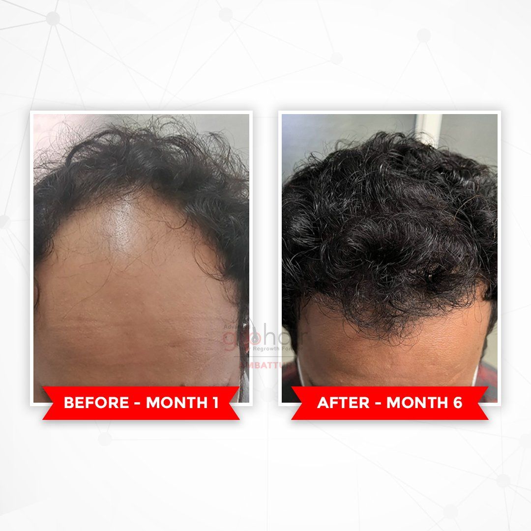 Before After 1