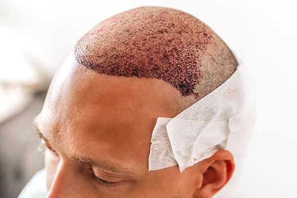Hair Transplant