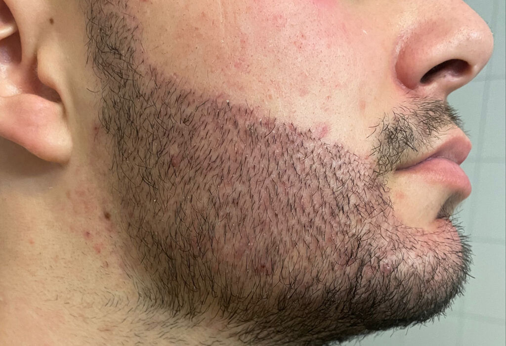 Beard Transplant