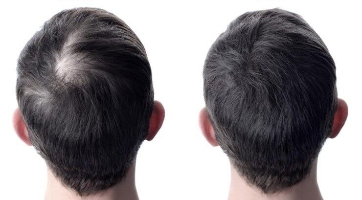 Hair Transplant Results - Before and After - Case 1