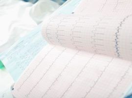 Analyzing ECG of patient in the hospital ward