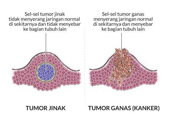 Awas Kenali Gejala Tumor Ini Sebelum Semakin Parah – Cekpremi Blog