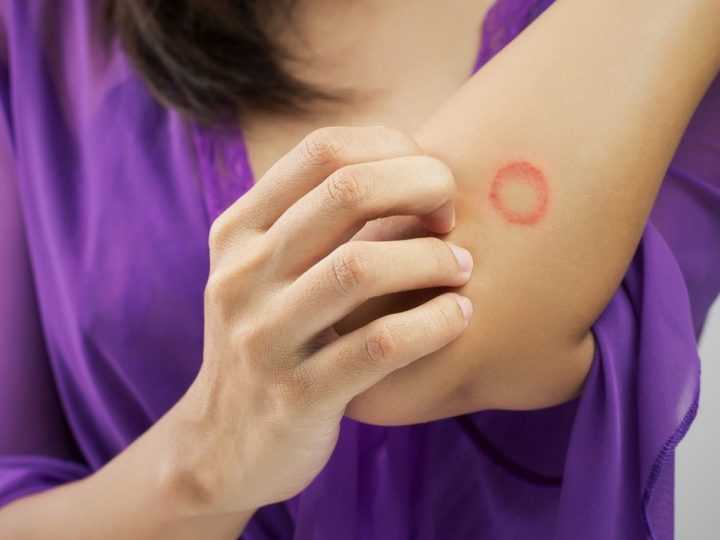 Infeksi Kulit Karena Jamur? Ini Cara Mengobati Ringworm Pada Manusia