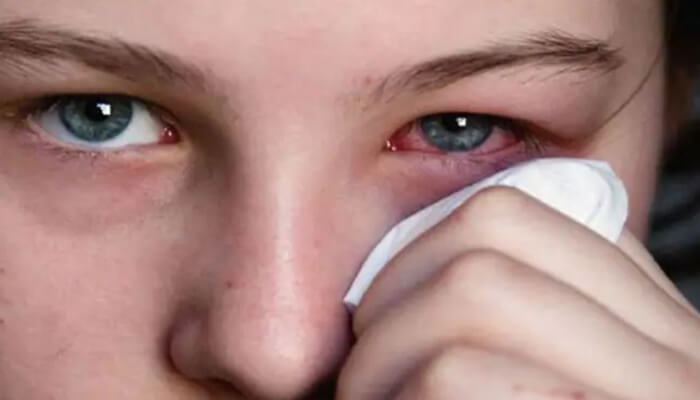 Eye Care Tips