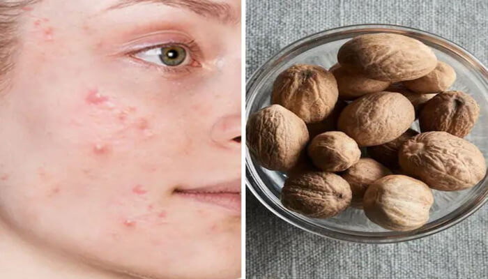 beauty tips मुंहासों से हैं परेशान तो अपनाएं ये अचूक देसी उपाय