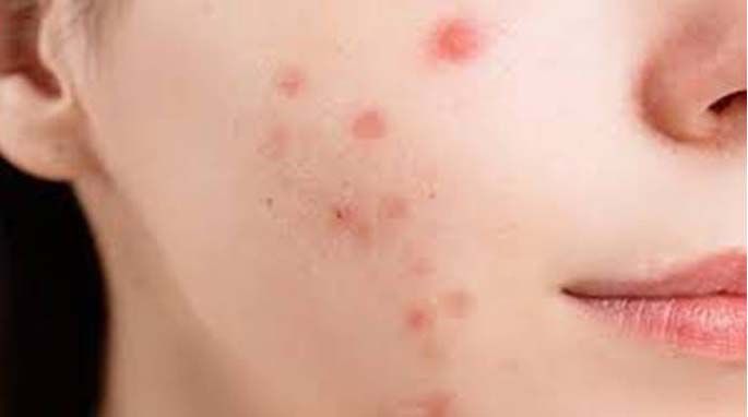 National Health News : चेचक से सात संदिग्ध मौतें, सितंबर से अब तक मुंबई में 164 मामले सामने आए : नगर निकाय