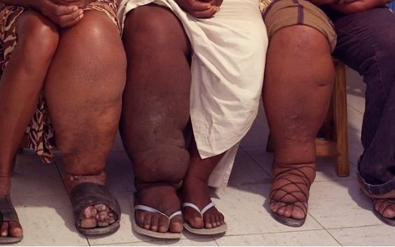 Health News : फाइलेरिया से निपटने के लिए स्वास्थ्य मंत्रालय का राष्ट्रव्यापी अभियान