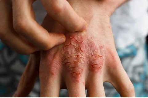 Psoriasis : एली लिली ने सोरायसिस की दवा पेश की