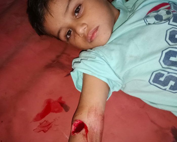 खूंखार बंदर ने 4 वर्षीय मासूम को दांतों से काट काट कर कर दिए जख्म