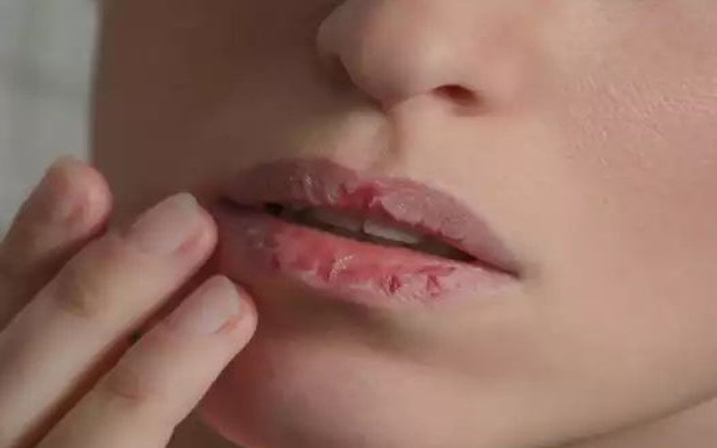 सर्दियों में होंठ फटने की परेशानी से पाएं छुटकारा, अपनाएं ये घरेलू और आयुर्वेदिक नुस्खे