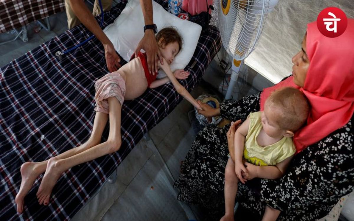 Gaza : गाजा में कुपोषण का संकट, हजारों बच्चे अस्पताल में भर्ती