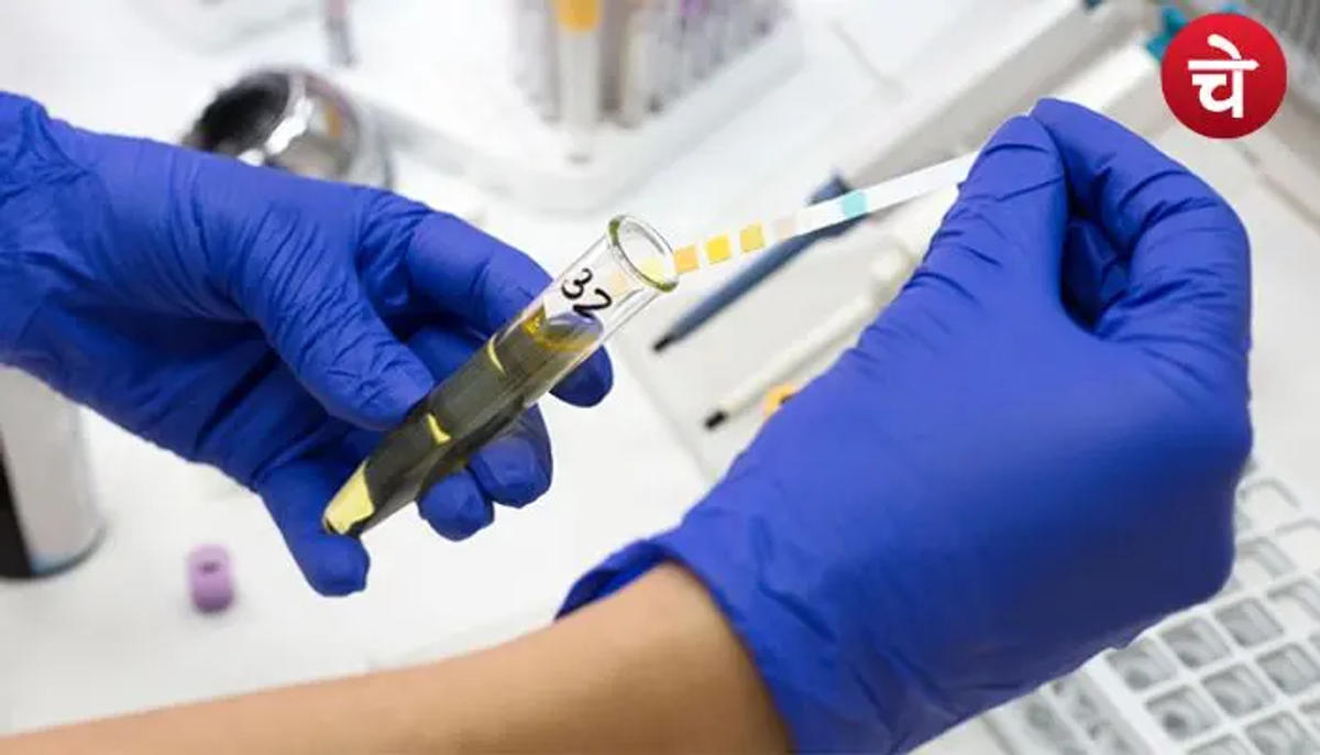 कब कराना चाहिए Urine Culture टेस्ट? इन लक्षणों को भूलकर भी नजरअंदाज न करें
