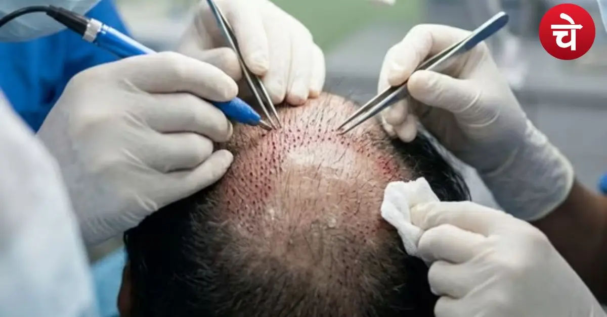 Hair Transplant Terrorist