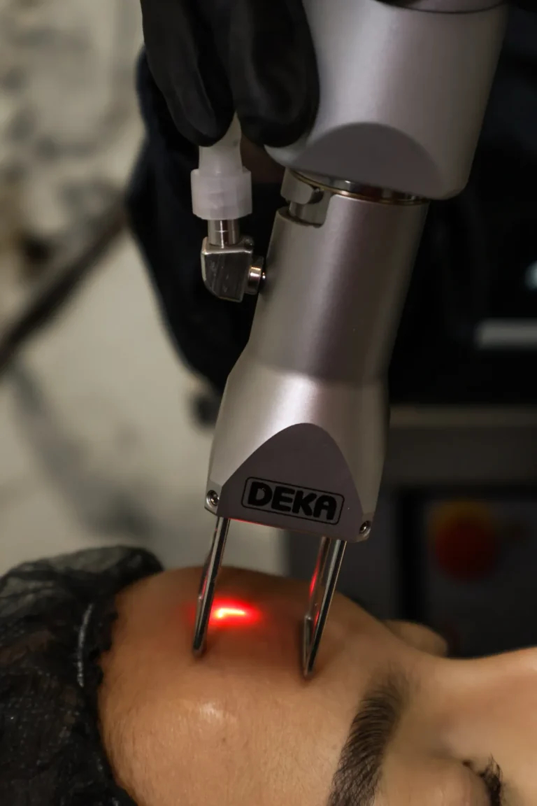 tratamiento laser co2 en monterrey