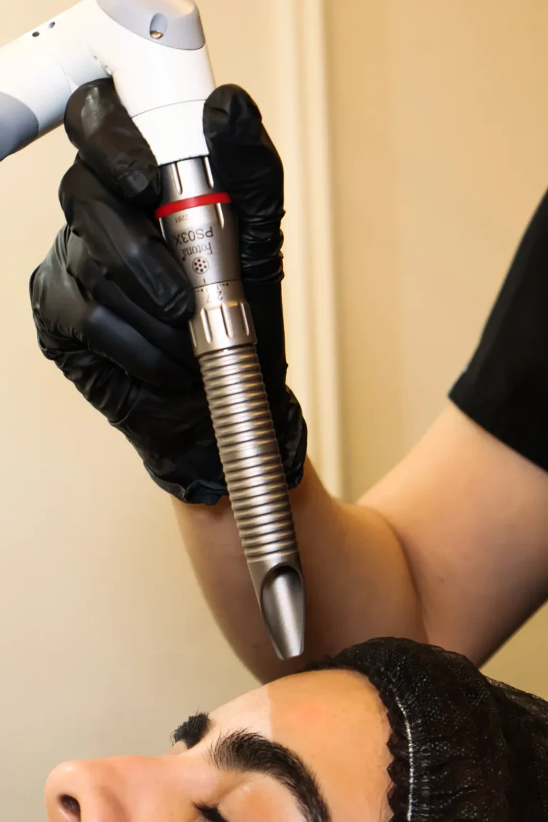 tratamiento Fotona Dynamis en monterrey