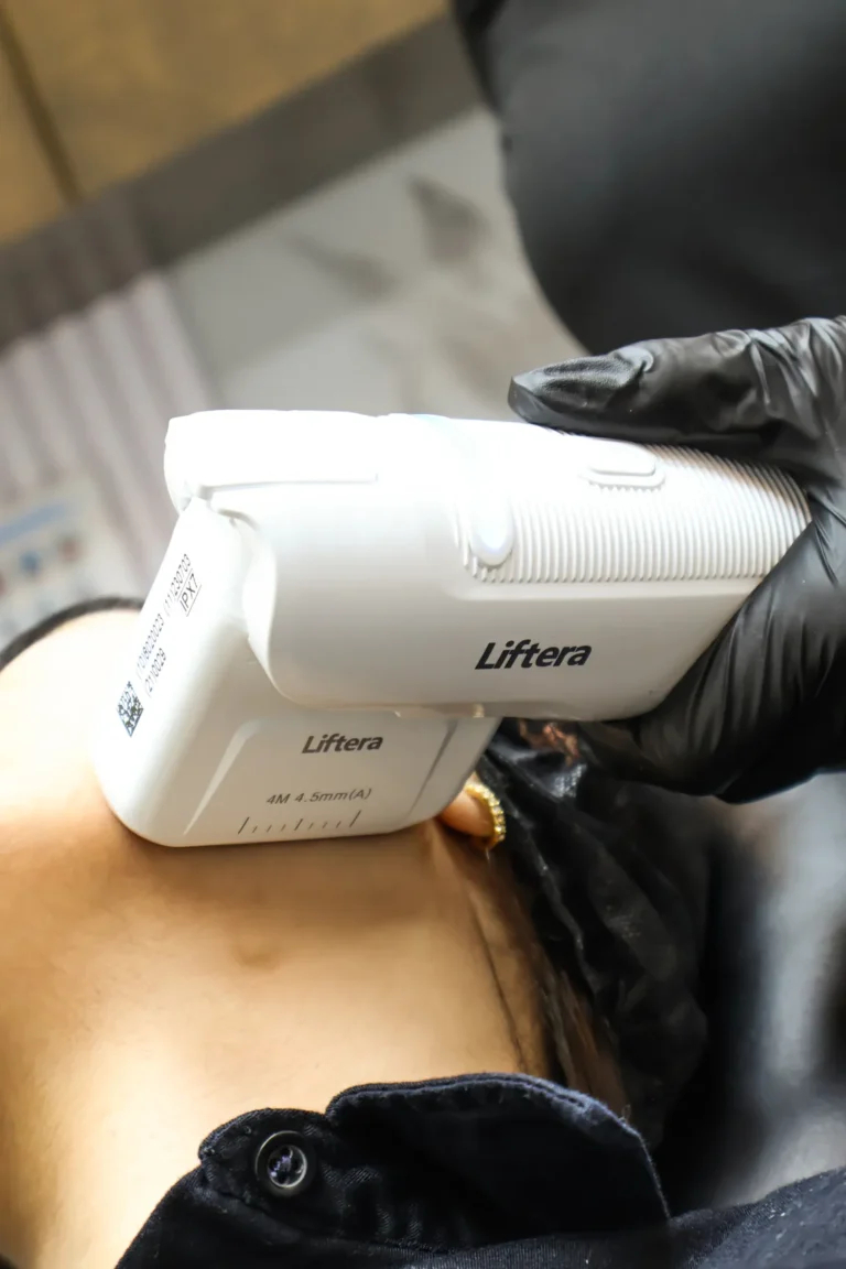 tratamiento liftera hifu en monterrey