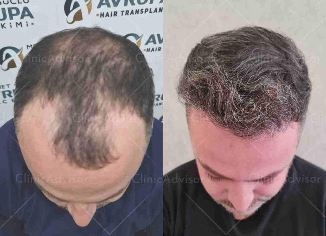 3500 grafts hair transplant Turkey