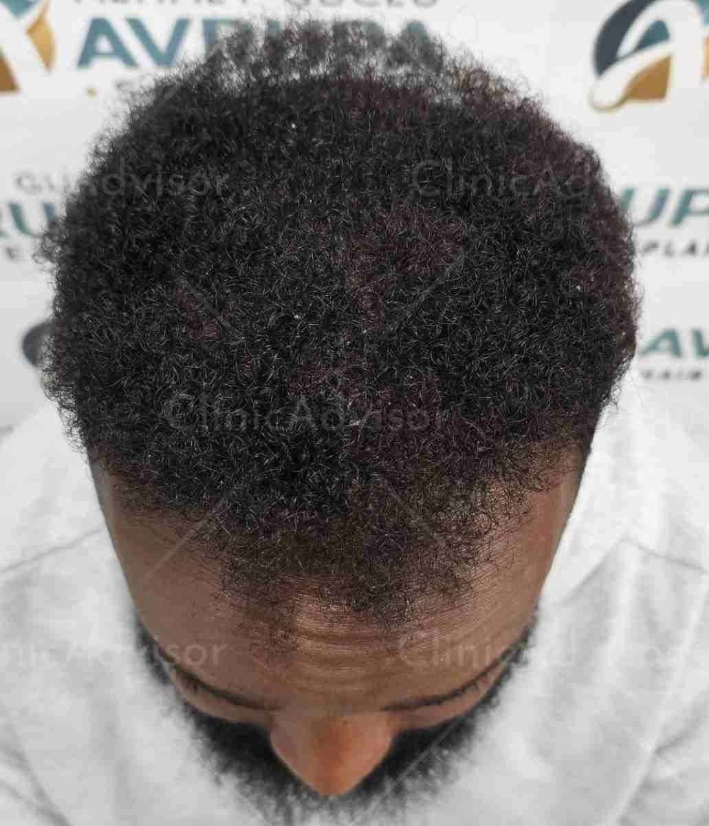 Afro hair transplant in Turkey