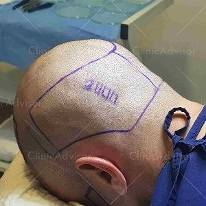 Donor area in hair transplant- important to get the best hair transplant