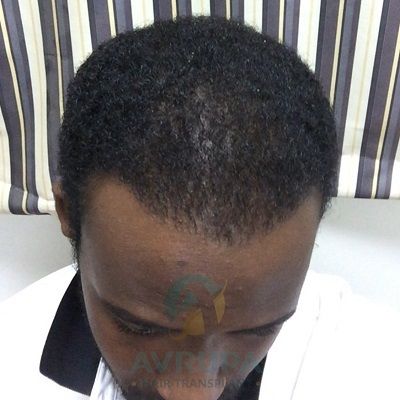 Afro hair transplant Turkey before after results 