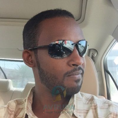 Afro hair transplant Turkey before after results 