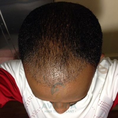Afro hair transplant Turkey before after results 