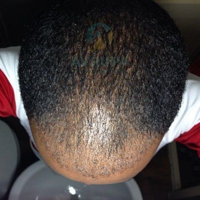 Black hair transplant Turkey before after results 