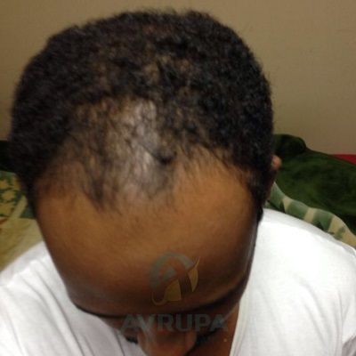 Afro/black hair transplant Turkey before after results 