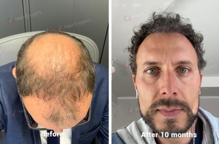 10 Months After Hair Transplant Surgery - 4000 Follicles