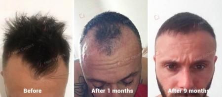 Sapphire Hair Transplant Result in Turkey - 2640 Hair Follicles